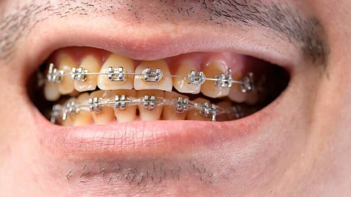 Can You Drink Coffee With Braces?: A closeup of a man's yellow plaque teeth with braces